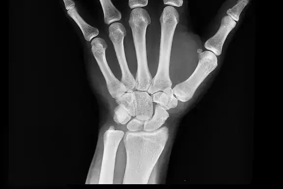 wrist x-ray - Radiography